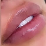 Resultado de tratamiento de labios en PHI Médica